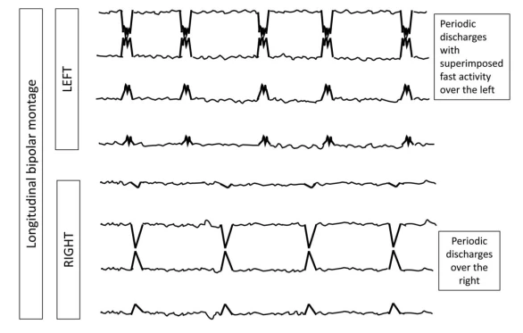 Electroclinical Seizure