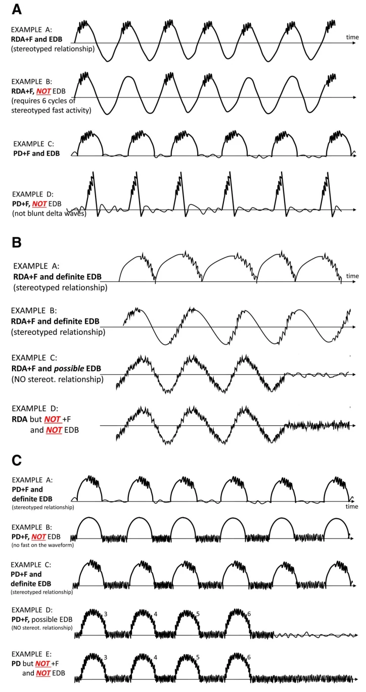 Electroclinical Seizure
